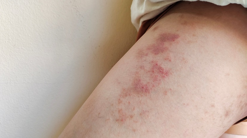 Czerwone plamy na nogach wywołane reakcją alergiczną