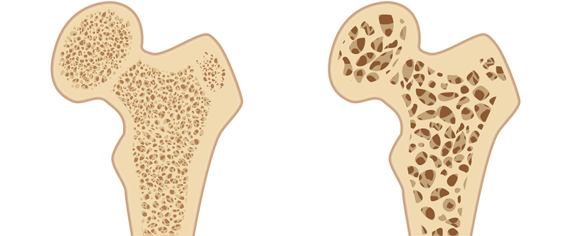 Zmiany w strukturze kości w przebiegu osteoporozy