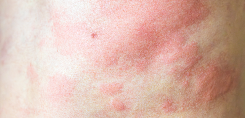Wysypka alergiczna - jak wygląda