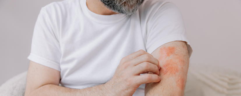Wysypka alergiczna – jak wygląda, co ją powoduje i jak ją leczyć?