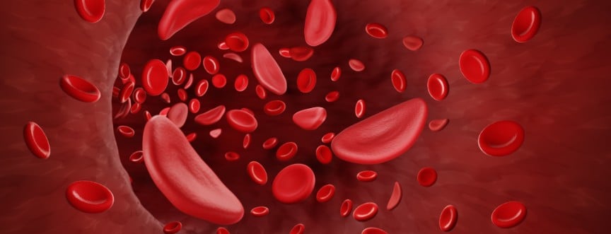 Anemia sierpowata – przyczyny, objawy, skutki