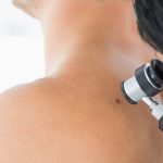 Dermatolog bada zmianę podczas dermatoskopii - diagnostyka czerniaka