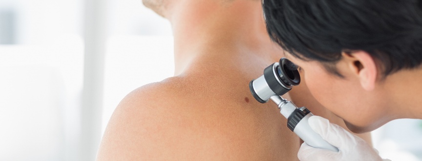 Dermatolog bada zmianę podczas dermatoskopii - diagnostyka czerniaka