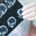Epilepsja to choroba neurologiczna, która bywa nazywana również padaczką.