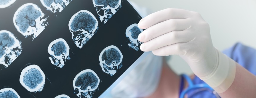 Epilepsja to choroba neurologiczna, która bywa nazywana również padaczką.