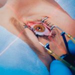 LASIK to laserowa operacja oczu / Fot. Adobe Stock