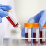 Małopłytkowość to zaburzenie polegające na występowaniu zbyt małej liczby płytek krwi.