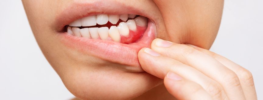 Najczęstsze choroby zębów i dziąseł – 4 najpowszechniejsze dolegliwości