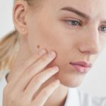 Narośl na skórze zawsze wymaga diagnostyki lekarskiej - niektóre zmiany są łagodne, jednak zawsze istnieje ryzyko rozwoju czerniaka.
