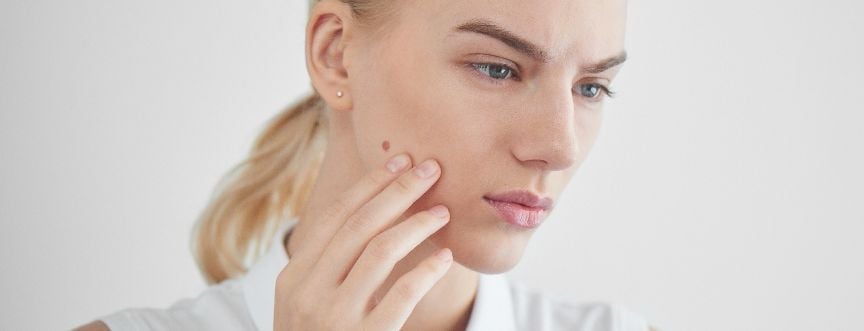 Narośl na skórze zawsze wymaga diagnostyki lekarskiej - niektóre zmiany są łagodne, jednak zawsze istnieje ryzyko rozwoju czerniaka.