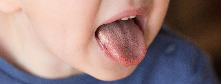 Nawracające afty na języku – co oznaczają? Jak je leczyć?