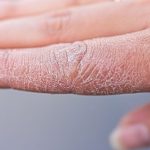 Pękająca skóra na palcach może być spowodowana nadmiernym wysuszeniem skóry.