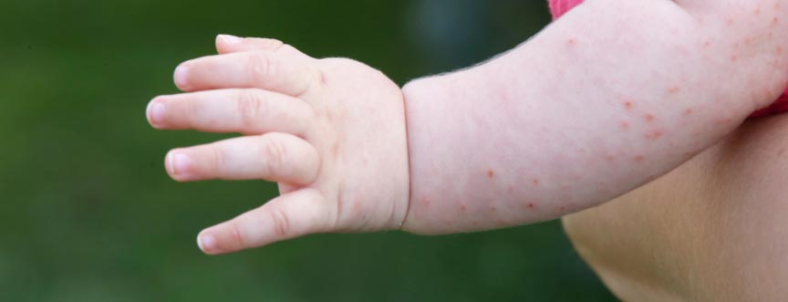 Potówki u niemowlaka – skąd się biorą? Co stosować na potówki u maluszka?