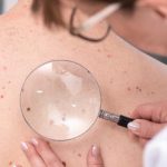 Lekarz dermatolog bada zmiany na plecach pacjenta pod kątem raka skóry.