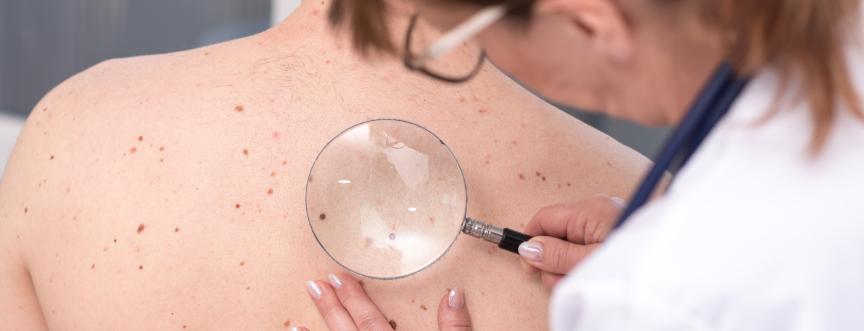 Lekarz dermatolog bada zmiany na plecach pacjenta pod kątem raka skóry.