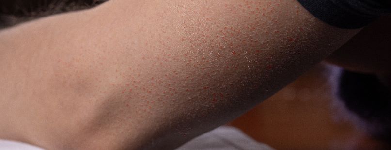 Rogowacenie mieszkowe – przyczyny i leczenie. Objawy rogowacenia mieszkowego u dzieci i dorosłych