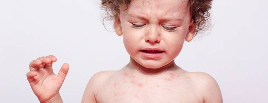 Różyczka – jak rozpoznać objawy choroby? Diagnostyka i leczenie