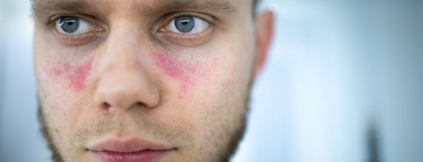 Toczeń rumieniowaty – objawy, leczenie. Czy toczeń jest zaraźliwy?