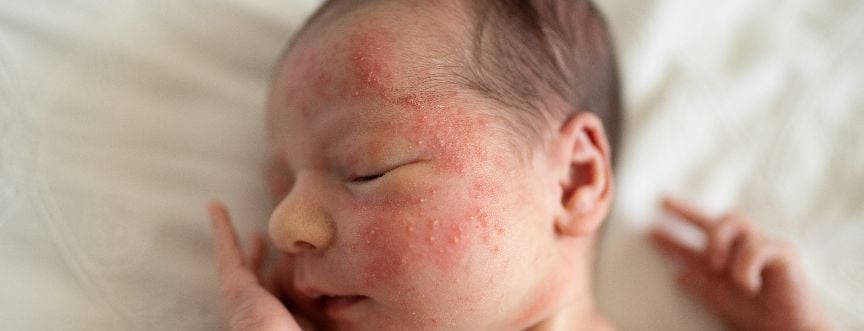 Trądzik niemowlęcy – jak leczyć krostki u dziecka?