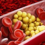 Wysoki poziom trójglicerydów wiąże się ze zwiększonym ryzykiem rozwoju miażdżycy.