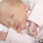 niemowlę z uszczypnięciem bociana na skórze