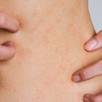Wysypka alergiczna na brzuchu kobiety