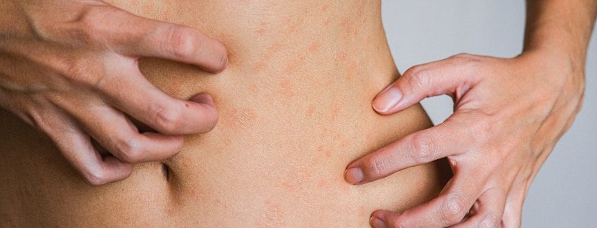 Wysypka alergiczna – jak wygląda i czym można ją leczyć?