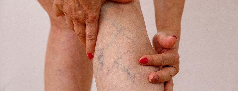 Żylaki – skąd się biorą i jak je leczyć?