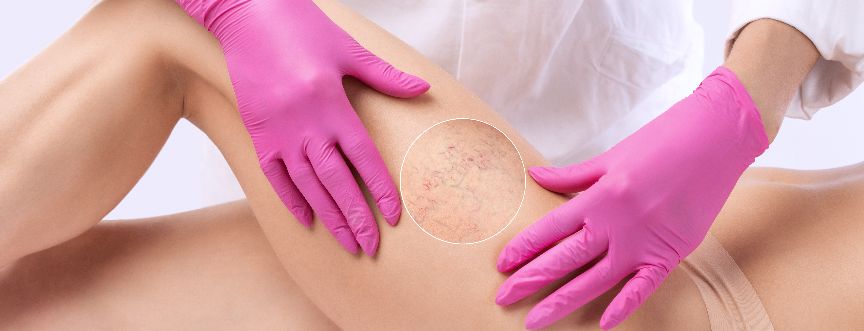 Skleroterapia to metoda leczenia żylaków.