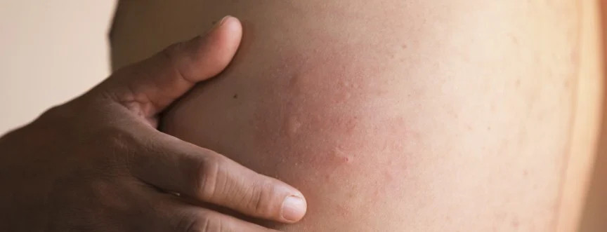 bąble pokrzywkowe na plecach pacjenta