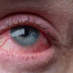 Jaglica - choroba oczu. Na zdjęciu osoba z przekrwionym, podrażnionym okiem