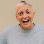 Uśmiechnięta kobieta z łysieniem plackowatym
