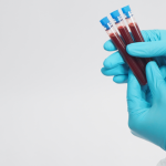 GGTP (gamma-glutamylotranspeptydaza)