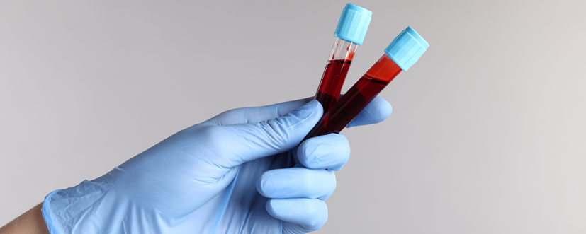 Gamma-globuliny – wskazania, przygotowanie, przebieg badania