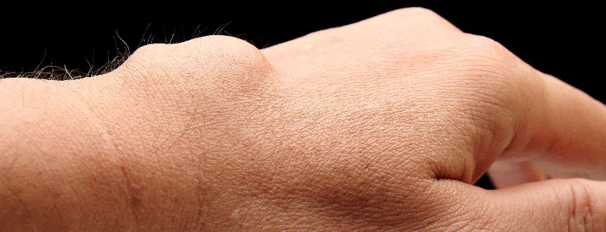 Ganglion może być twardy. Zawsze jednak można go przesuwać pod skórą.