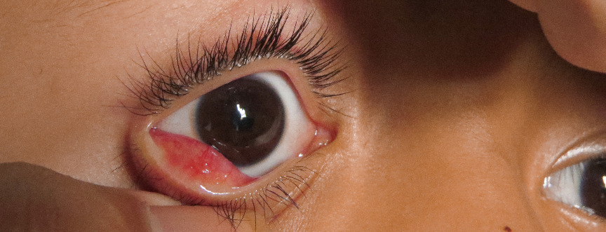 Tak wygląda gradówka na oku.