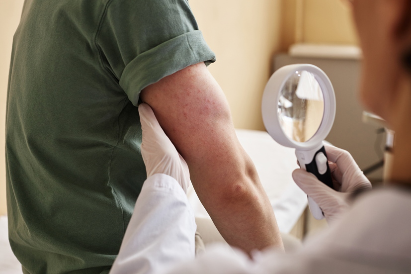 plamica Schönleina-Henocha - diagnostyka