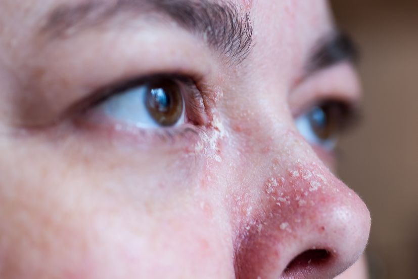 Łuszczyca na twarzy – ilustracja do artykułu dermatologicznego
