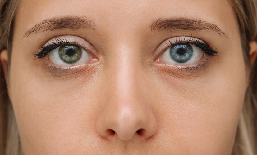 Heterochromia całkowita, różnokolorowe tęczówki - jedno oko ma kolor niebieski, drugie zielony