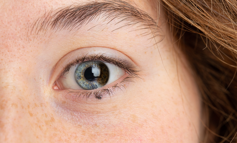 Heterochromia sektorowa (częściowa) - inny kolor części tęczówki
