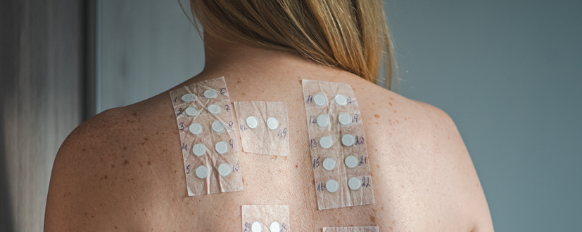 Alergia kontaktowa – objawy, przyczyny i leczenie. Jak rozpoznać uczulenie kontaktowe?