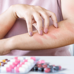 Alergia na leki