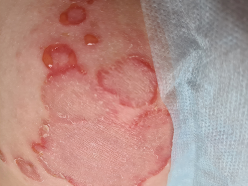 Alergia na pieluchy (pampersy)