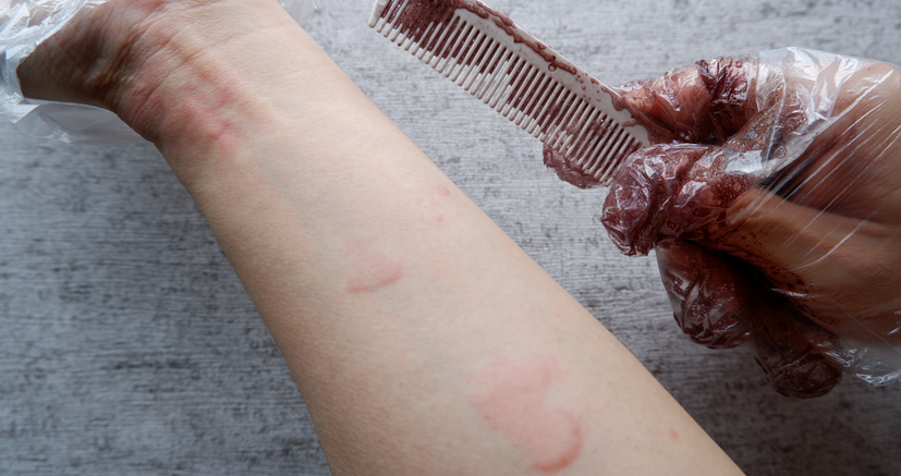 Reakcja alergiczna widoczna na ręce