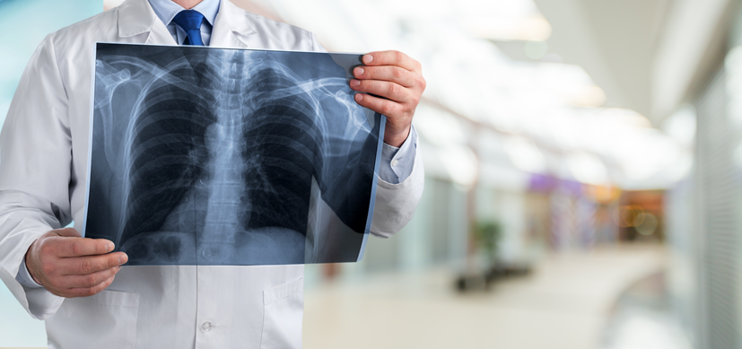 Niskodawkowa tomografia komputerowa płuc
