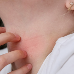 Alergia na nikiel