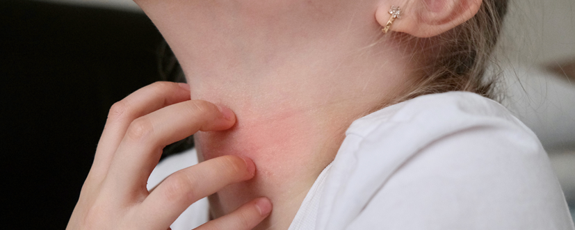 Alergia na nikiel – objawy, diagnostyka i leczenie. Jak rozpoznać uczulenie na nikiel?
